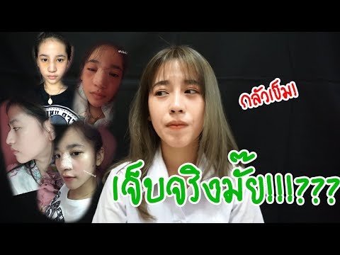 รีวิวศัลยกรรมทำจมูกครั้งแรกในชีวิต ไม่เจ็บเลย! ( ดูก่อนตัดสินใจทำ ) | Keno ❤️