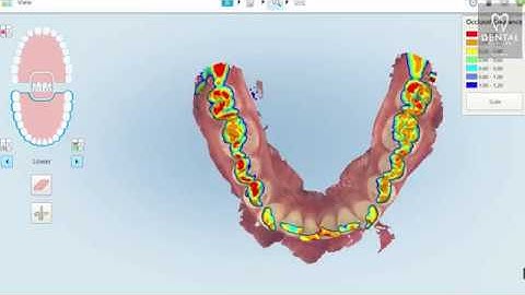 The 3D iTero Scan -Invisalign Singapore by Dental Designs Clinic