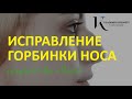 Ринопластика - Исправление горбинки носа, длинного кончика носа - хирург Владимир Косинец