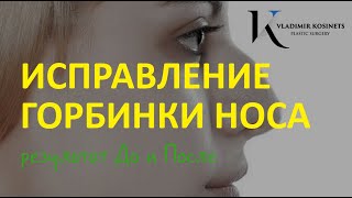 Ринопластика - Исправление горбинки носа, длинного кончика носа - хирург Владимир Косинец