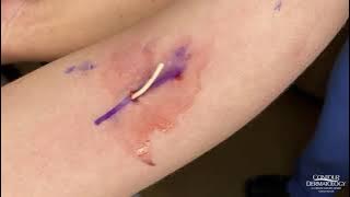 Arm Implant Removal | CONTOUR DERMATOLOGY