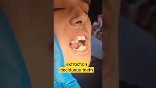 خلع اسنان الأطفال |extraction deciduous teeth| خلع ضروس الاطفال#extraction_teeth