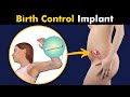 Birth control progestin implant  contraceptive implant