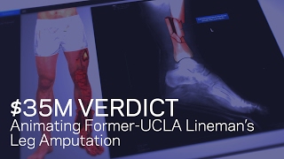 $35M Verdict Animating Former-UCLA Lineman’s Amputation
