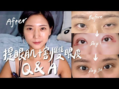 【提眼肌+割雙眼皮Q&A】手術總花費？診所醫生？批評聲音心理調適？恢復期6個月心路歷程！｜大小眼 眼皮下垂 提眼肌無力｜林宣 Xuan Lin