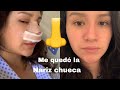 (RINOPLASTIA/SEPTOPLASTIA) me quedó CHUECA! Mi experiencia