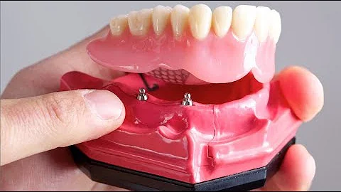 FAQ: How can dental implants help my dentures fit better? | Yenzer Family Dentistry