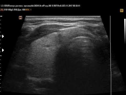 Аплазия щитовидной железы. Аплазия доли щитовидной железы УЗИ. Аплазия щитовидной железы на УЗИ. Аплазии левой доли щитовидной. Аплазия левой доли щитовидки.