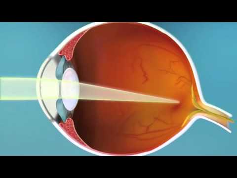 Video: Identificering Af Mere Pålidelige Parametre Til Påvisning Af ændringer Under Opfølgningen Af milde Til Moderate Keratoconus-patienter