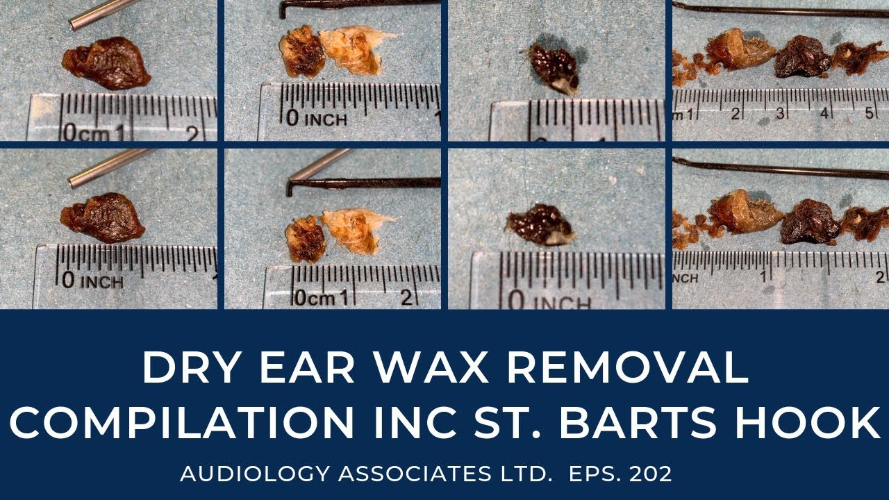DRY EAR WAX REMOVAL COMPILATION IN ST BARTS HOOK EP 202 YouTube