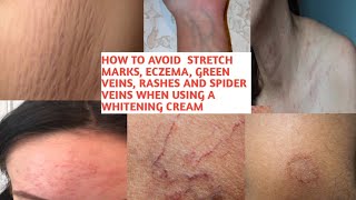 Add this into your whitening cream to AVoid Stretch marks, EcZema, Green veins and Spider veins.