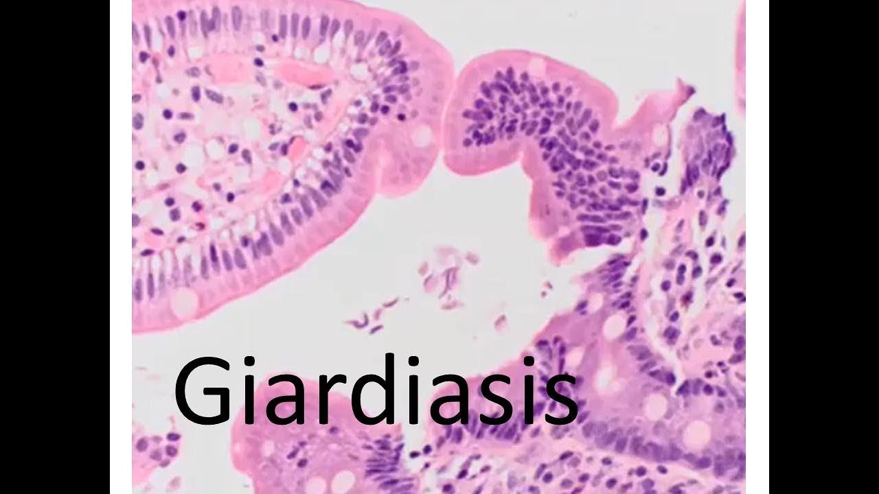 Giardia duodenum histopathology Giardiasis duodenum histology