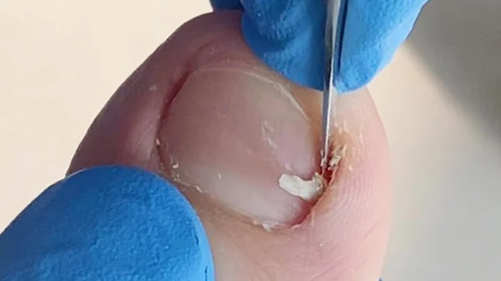 Pedicure Tutorial: Large ingrown nails hidden unde...