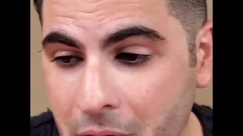 Beard Micropigmentation