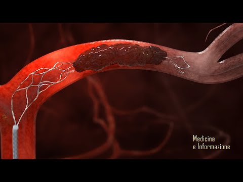 Video: Trombectomia: Tipi Di Intervento Chirurgico, Indicazioni, Risultati