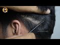 Biggest Dandruff Flakes In Hair Removal - Dandruff Scratching | Mr Dandruff Flakes #62
