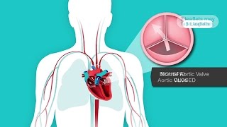 Learn About Bicupsid Aortic Valves and Mitral Valve Prolapse