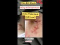 Phân Biệt Nhanh: Bỏng Kiến Ba Khoan và Zona Thần Kinh (Dời Leo)!