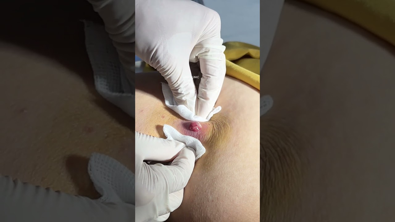 Mụn nhọt mông viêm nặng xử lý sai rất dễ TÁI LẠI