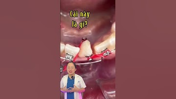 A! Giải pháp cho răng xoay. Button trợ thủ đắc lực trong niềng răng. #niengrang