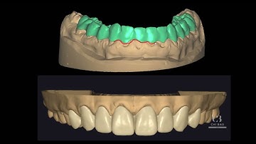 Thiết kế Snap-On Smile (concept) trên Exocad - 1. Giới thiệu