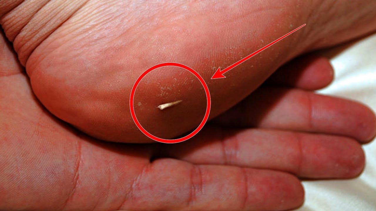 How to remove a splinter easily? YouTube