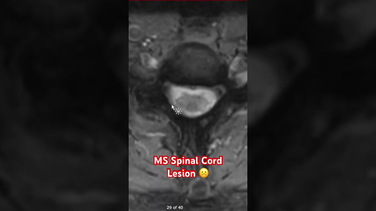 MS Spinal Cord Lesion 