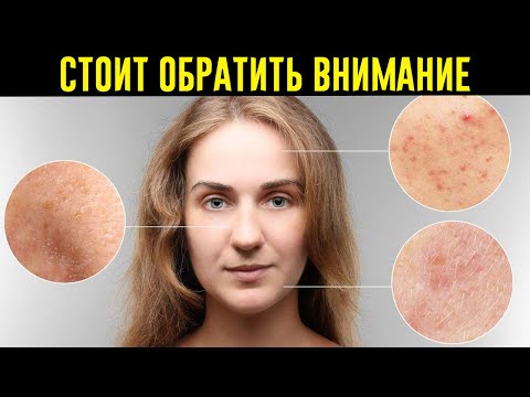 8 Серьезных Заболеваний, о Которых Говорит Наша Кожа!