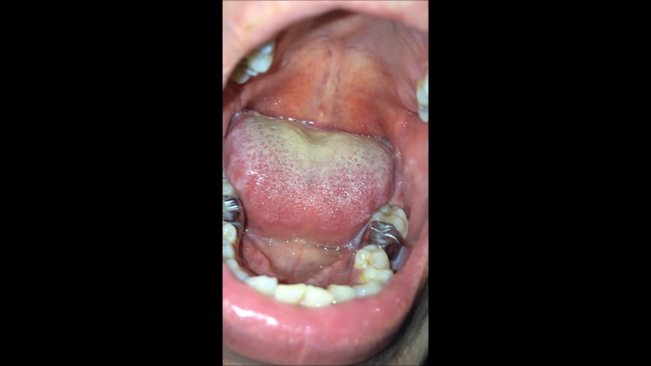 Skys Uvula And Tongue Ulcer Youtube