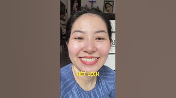 Niềng răng có hết lệch mặt không ?