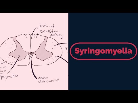 Syringomyelia Rapid Review