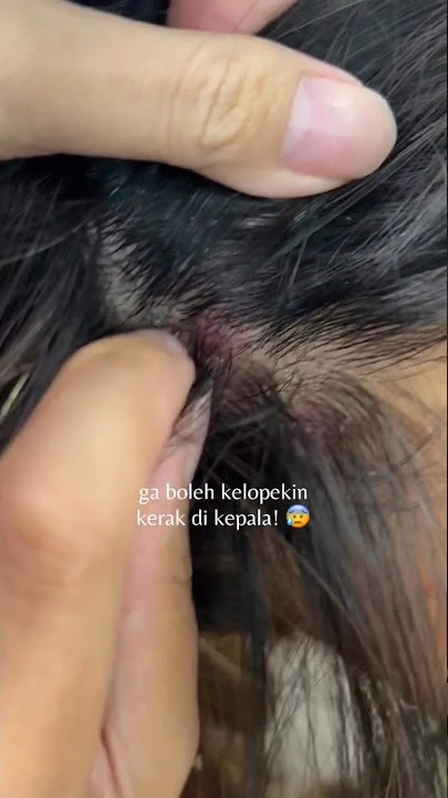 stop jangan lakuin kalo ga mau makin parah #fypシ #viral #perawatanrambut #psoriasis #dermatitis #fyp