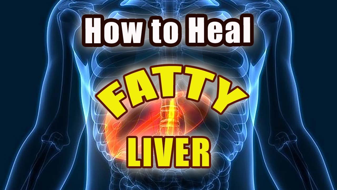 How to Heal Fatty Liver What to do about Fatty Liver Doc
