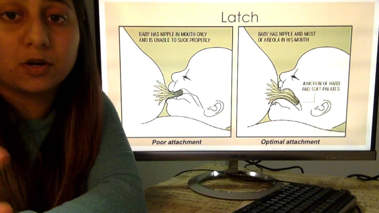 Candida Albicans and the Infant With Cleft Lip Breastfeeding