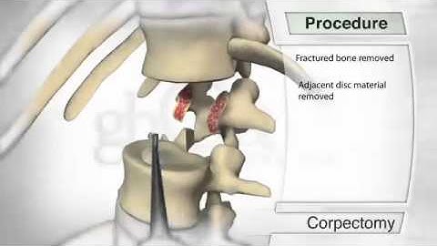 Corpectomy Procedure Animation