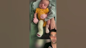Casting for club foot deformity