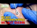 The best blackheads removal by dr lalit kasana  blackheads removal  dr lalit kasana  new