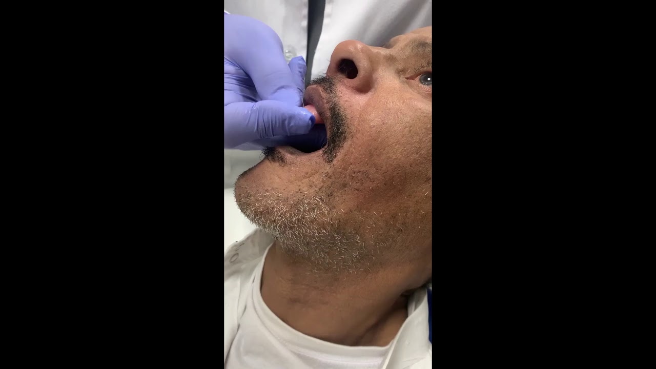 Border molding upper tray with green stick