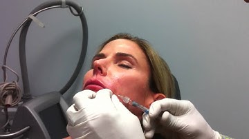 Blunt Cannula technique for lip enhancement II, Steve Weiner, MD, Destin