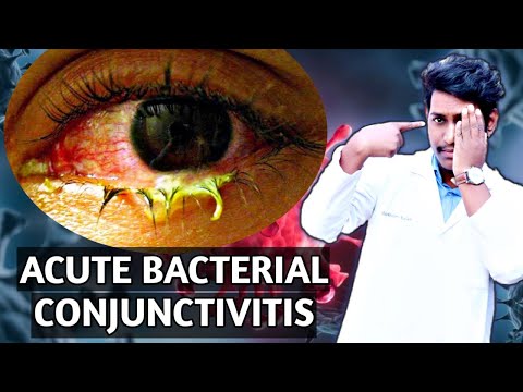 Video: Purulent Conjunctivitis - Treatment, Acute Purulent Conjunctivitis Of The Eye In Children