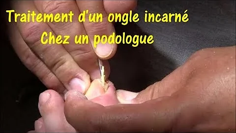 Comment soigner un ongle de doigt de pied bleu ?