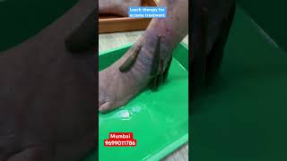 Is leech therapy expensive? #kzhijama #leechtherapy #leech #shortvideo #reels #viral #youtube #reel