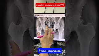 ปวดสะโพก สาเหตุและการรักษาคือ Part 1#หมอเก่งกระดูกและข้อ #ปวดข้อสะโพก #ข้อสะโพกเสื่อม #ข้อสะโพกเทียม
