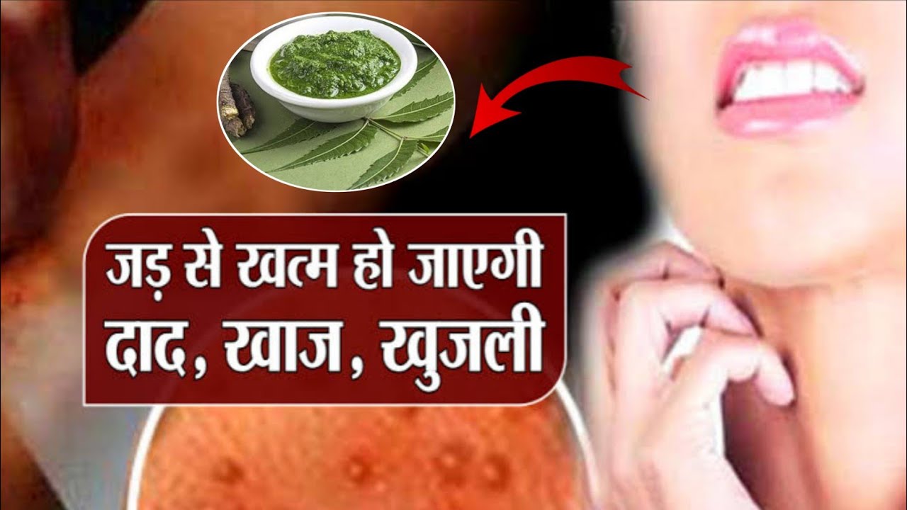 2 दिन दाद खाज खुजली का 100 देसी इलाज Daad Khaj Khujli ke Upay I