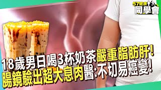 18歲大學生日喝3杯奶茶「嚴重脂肪肝」！大腸鏡驗出「超大息肉」醫嚇：不切容易癌變！？【 @57healthy  】#張振榕 醫師