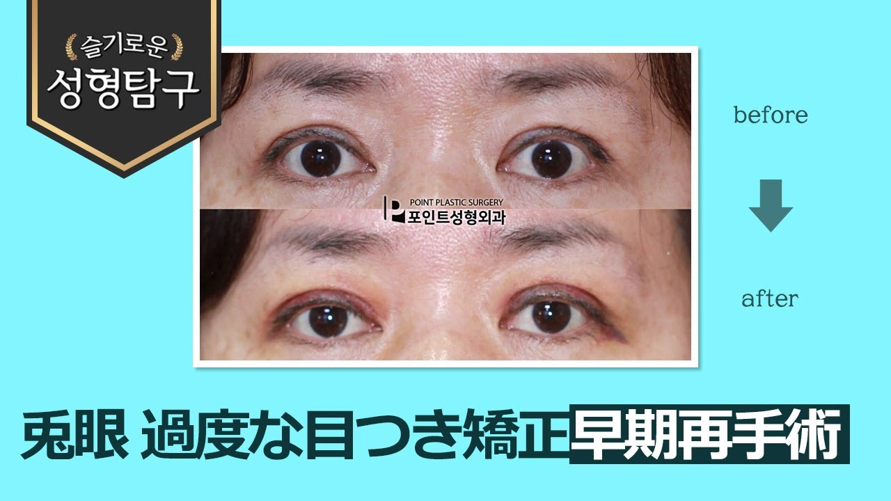 【韓国二重修正】過度な目つき矯正によるびっくり目、早期二重再手術