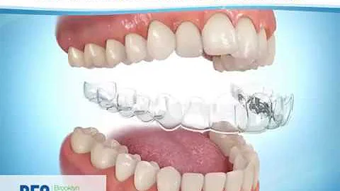 Aligner Care