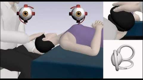 Maneuvers to Diagnosis and Treat Benign Paroxysmal Positional Vertigo | NEJM