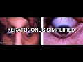 Keratoconus Complete Lecture | Signs, Symptoms, Diagnosis, Topography, Management &amp; Hydrops #cornea 