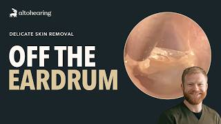 The Most Delicate Ear Wax Removal We Do - Skin Peels Off The Eardrum Ep033